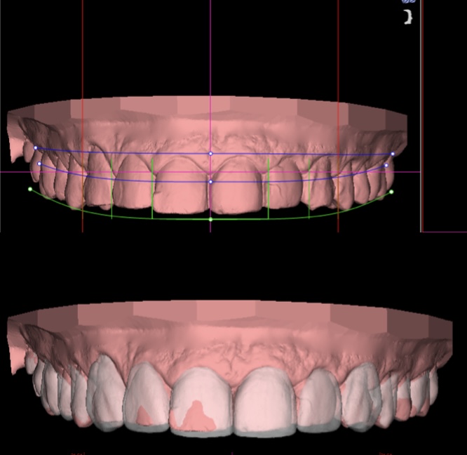 Digital smile design planning for veneers at Mori Dental