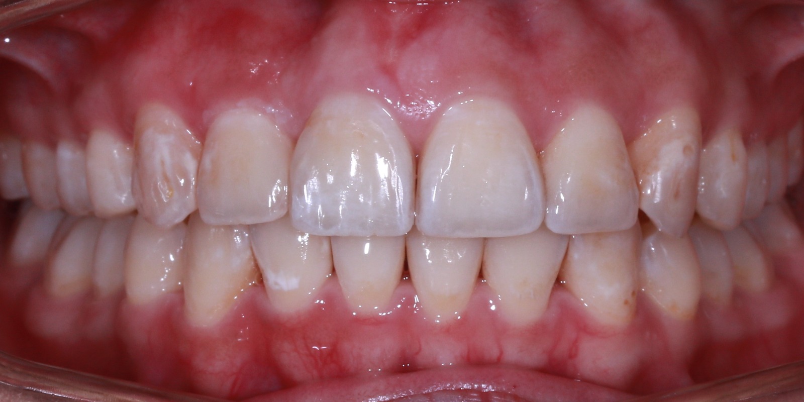 Anterior After
