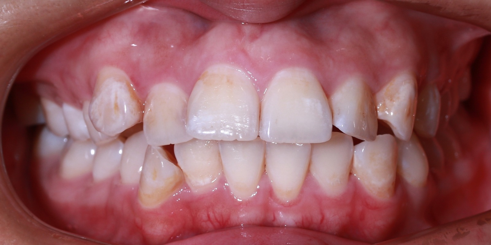 Anterior Before