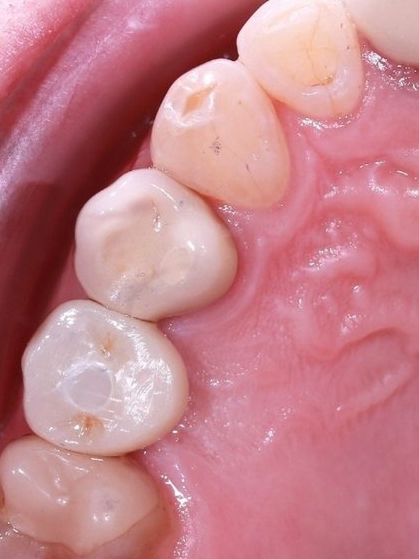 ba_implant_1_after