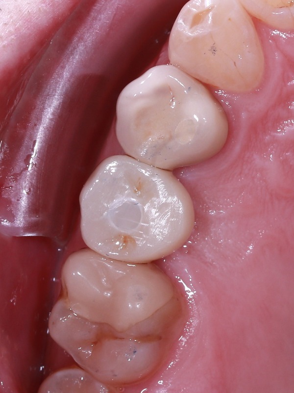 ba_implant_2_after