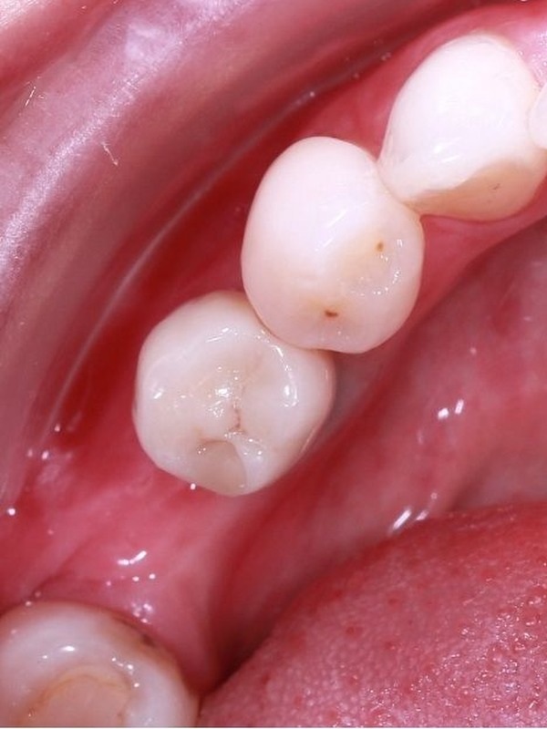 ba_implant_3_after