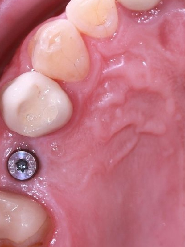 v2_implant_1_before