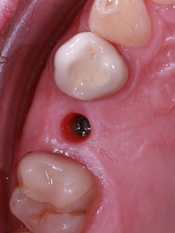 v2_implant_2_before