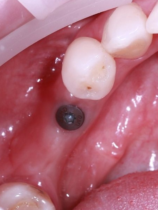 v2_implant_3_before