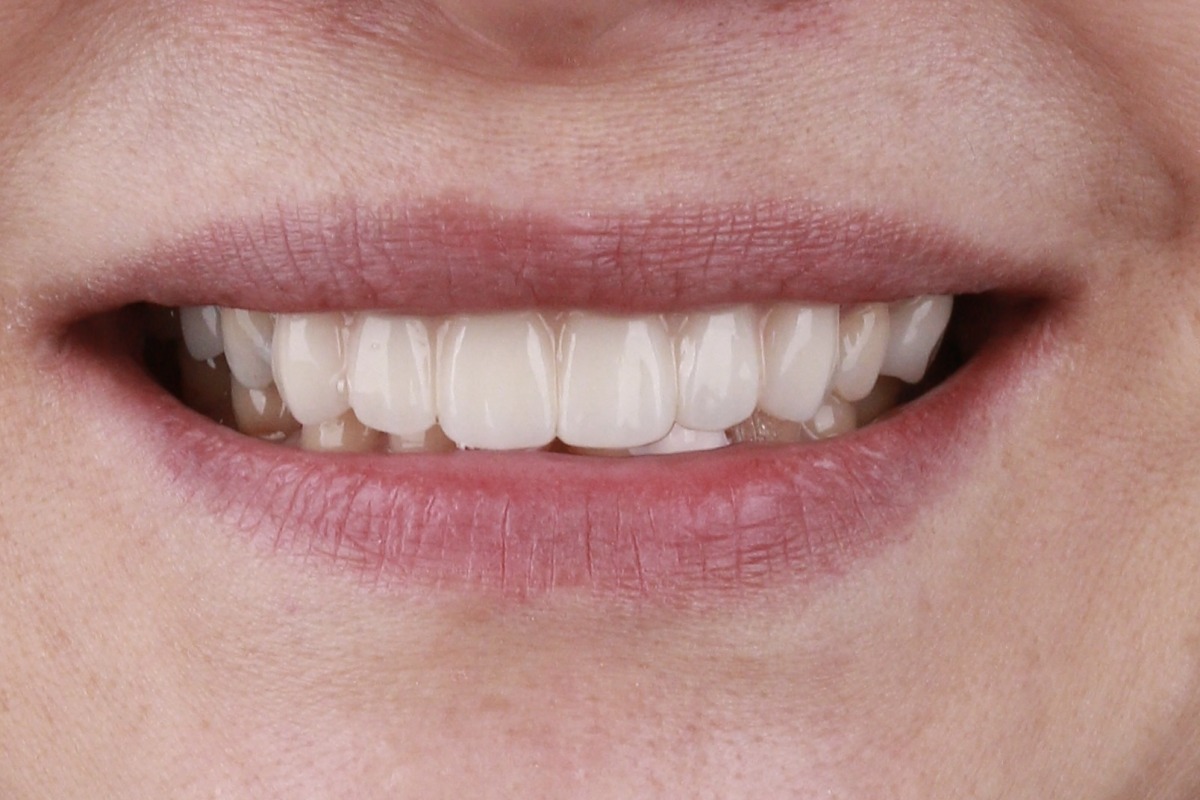 veneer_1_after