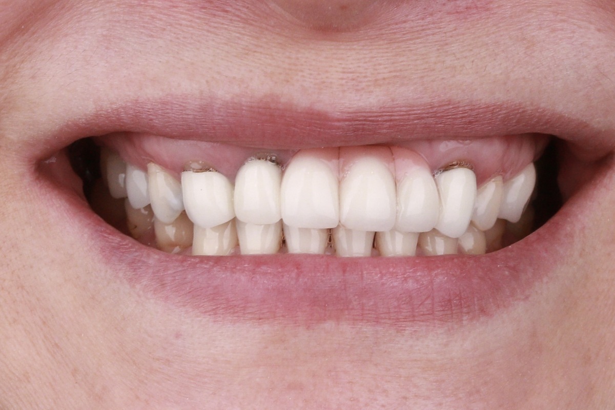 veneer_1_before veneer_1_before