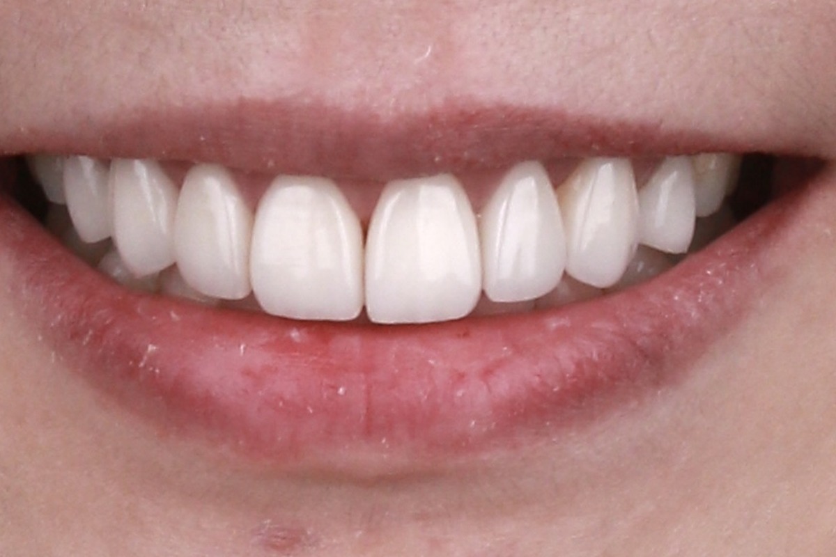 veneer_2_after