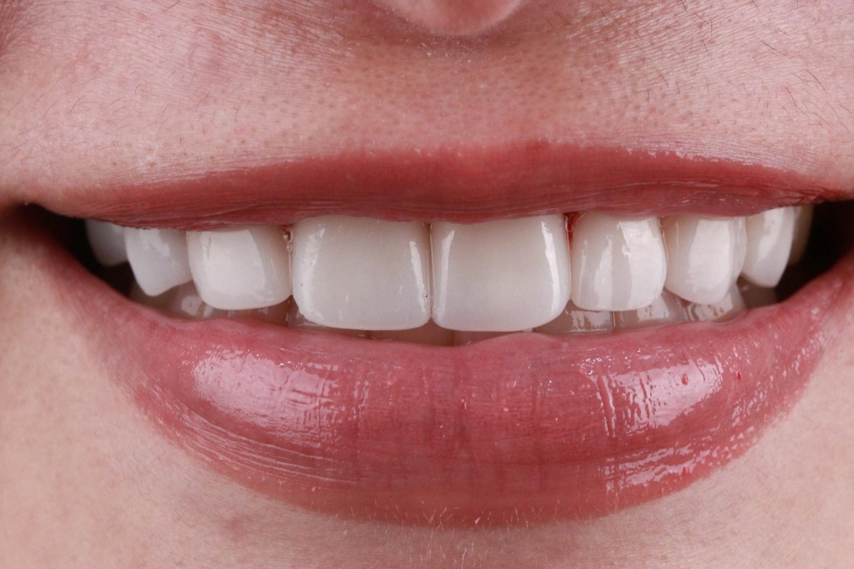 veneer_3_after