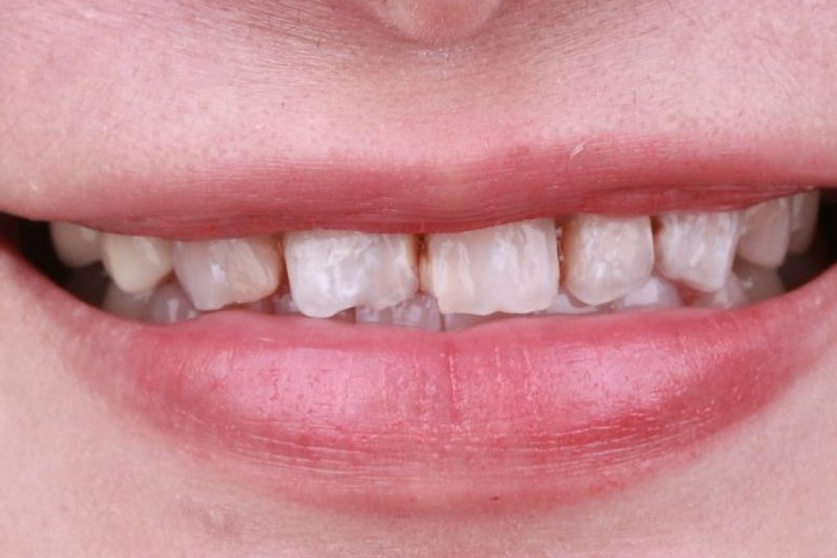 veneer_3_before veneer_3_before