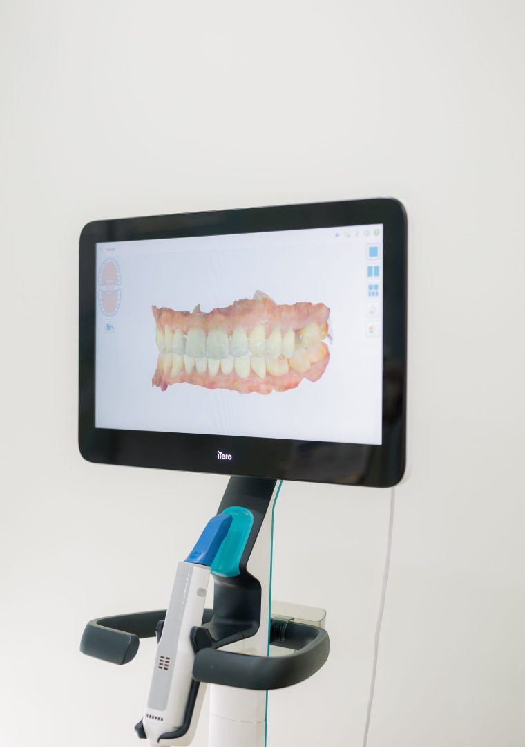 IteroScanner